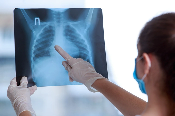 Doctor examines an X-ray of a lung